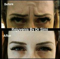 25 Units Of Botox For Furrowed Brow
