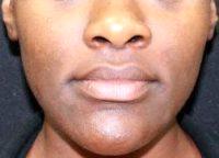 25 Year Old Female Treated With Juvederm For Nasolabial Folds By Dr. Shaun Patel, MD, Miami Physician