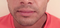 25 Year Old Man Treated With Botox For Jawline With Doctor Munir Somji, BSc, MBBS, London Physician