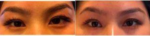 25 Year Old Woman Brow Lift With ThermiSmooth By Doctor Susan F. Lin, MD, San Mateo OB-GYN