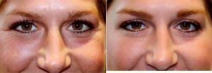 25 Year Old Woman Treated With Botox By Dr. James R. Gordon, MD, FACS, FAAO, New York Oculoplastic Surgeon