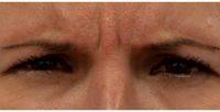 25 Year Old Woman Treated With Botox For Brow Lines By Dr. Karol A. Gutowski, MD, FACS, Chicago Plastic Surgeon
