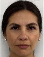 25 Year Old Woman Treated With Juvederm By Doctor Maria Milone, MBBS, Melbourne Physician