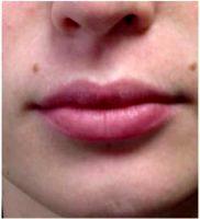 25 Year Old Woman Treated With Juvederm By Dr John J. Corey, MD, Phoenix Plastic Surgeon