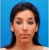 25 Year Old Woman Treated With Juvederm By Dr Mark Beaty, MD, Atlanta Facial Plastic Surgeon