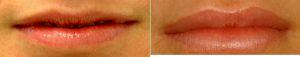 25 Year Old Woman Treated With Restylane Before & After By Doctor Mark Taylor, MD, Salt Lake City Dermatologic Surgeon