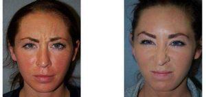26 Year Old Female, Botox, Glabella And Forehead Before And After By Dr. Steven Yarinsky, MD, Albany Plastic Surgeon