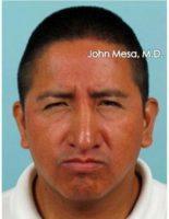 26 Year Old Latin Man Treated With Botox For Glabella Wrinkles ('11's') With Dr John Mesa, MD, New York Plastic Surgeon