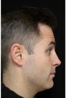 30 Year Old Man Treated With Botox Before And After With Dr. Michele S. Green, MD, New York Dermatologist