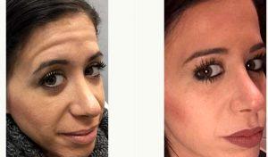 26 Year Old Woman Treated With Botox And Restylane With Dr Justin Harper, MD, Columbus Physician
