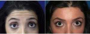 26 Year Old Woman Treated With Botox And Restylane With Dr. John Diaz, MD, Beverly Hills Plastic Surgeon