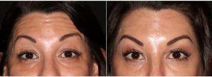 26 Year Old Woman Treated With Botox With Doctor Rebecca Baxt, MD, Paramus Dermatologic Surgeon