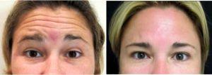 26 Year Old Woman Treated With Botox With Dr Joshua Lampert, MD,FACS, Miami Plastic Surgeon