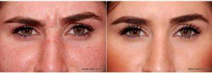 26 Year Old Woman Treated With Botox With Dr Stephen Weber, MD, FACS, Denver Facial Plastic Surgeon