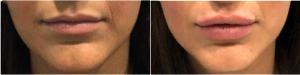 26 Year Old Woman Treated With Juvederm With Doctor Justin Harper, MD, Columbus Physician