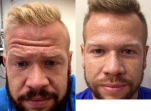 27 Year Old Man Treated With Botox And Filler Before And After With Dr. Cylburn E. Soden Jr., MD, Laurel Dermatologic Surgeon