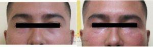 27 Year Old Man Treated With Restylane Before & After With Doctor Elham Jafari, MD, Irvine Physician