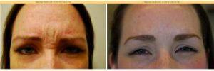 27 Year Old Woman Treated With Botox Before And After With Dr Kathleen Morno, MD, Highland Park Physician
