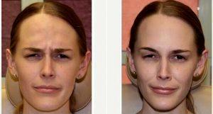 27 Year Old Woman Treated With Botox With Dr. Jimmy S. Firouz, MD, FACS, Beverly Hills Plastic Surgeon