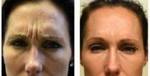 27 Year Old Woman Treated With Botox for A Furrowed Brows With Dr. Peter N. Butler, MD, Pensacola Plastic Surgeon