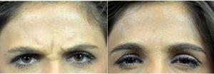 28 Year Old Woman Treated With Botox for A Furrowed Brows By Doctor Mark Hamilton, MD, Indianapolis Facial Plastic Surgeon