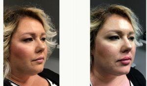 28 Year Old Woman Treated With Juvederm By Doctor Justin Harper, MD, Columbus Physician