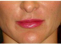 28 Year Old Woman Treated With Juvederm For Lips By Doctor Parker A. Velargo, MD, New Orleans Facial Plastic Surgeon