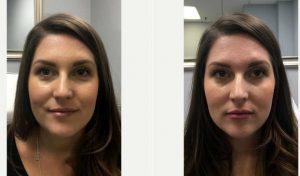 29 Year Old Woman Treated With Botox Before & After By Dr. Justin Harper, MD, Columbus Physician