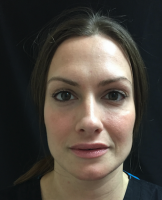 29 Year Old Woman Treated With Botox With Doctor Michele S. Green, MD, New York Dermatologist