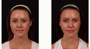 29 Year Old Woman Treated With Dysport By Dr Andrew P. Trussler, MD, Austin Plastic Surgeon
