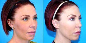 29 Year Old Woman Treated With Restylane Before & After With Dr Landon Pryor, MD, FACS, Rockford Plastic Surgeon