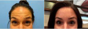 30 Year Old Woman Treated With Botox Before And After With Dr. Neil Tanna, MD, FACS, New York Plastic Surgeon
