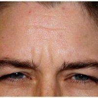 30 Year Old Woman Treated With Botox By Dr. Stephen P. Beals, MD, Paradise Valley Plastic Surgeon