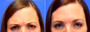 30 Year Old Woman Treated With Botox for A Furrowed Brows By Dr Jason Brett Lichten, MD, Columbus Plastic Surgeon