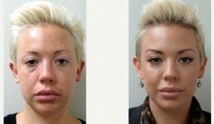 31 Year Old Woman Treated With Botox And Restylane