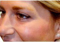 31 Year Old Woman Treated With Botox Before And After By Dr. James R. Gordon, MD, FACS, FAAO, New York Oculoplastic Surgeon