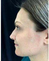 31 Year Old Woman Treated With Botox For Crow's Feet By Dr Michele S. Green, MD, New York Dermatologist