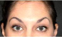 31 Year Old Woman Treated With Botox With Doctor John Paletta, MD, Savannah Plastic Surgeon