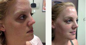 31 Year Old Woman Treated With Juvederm By Dr. Nicholas Snavely, MD - Austin Dermatologic Surgeon
