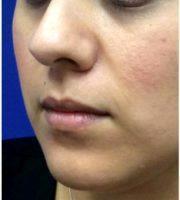 31 Year Old Woman Treated With Juvederm For Lip Fullness. With Dr Karan K. Sra, MD, Webster Dermatologist