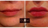 31 Year Old Woman Treated With Juvederm For Lips By Dr. Homan Siman, MD, Encino Physician