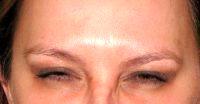32 Year Old Female For Frown Lines By Dr. Matthew Doppelt, DO, Knoxville Dermatologist