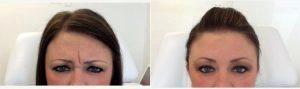 32 Year Old Woman Treated With Botox By Doctor Quenby Erickson, DO, FAAD, FACMS, Chicago Dermatologic Surgeon