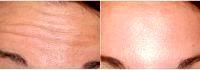 32 Year Old Woman Treated With Botox By Doctor Timothy Mountcastle, MD, Ashburn Plastic Surgeon 985