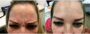 32 Year Old Woman Treated With Botox For A Furrowed Brows