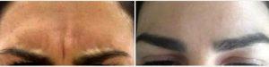 32 Year Old Woman Treated With Botox for A Furrowed Brows With Dr Suji Park-Idler, MD, Raleigh-Durham Internist