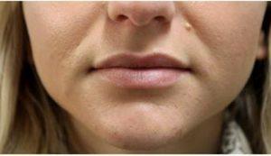 32 Year Old Woman Treated With Juvederm By Doctor Albert W. Chow, MD, San Francisco Plastic Surgeon