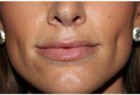 32 Year Old Woman Treated With Juvederm With Dr Rebecca Baxt, MD, Paramus Dermatologic Surgeon
