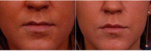 32 Year Old Woman Treated With Restylane Before & After With Dr. Thomas J. Walker, MD, Atlanta Facial Plastic Surgeon