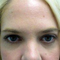 32 Year Old Woman Treated With Restylane By Dr. Tina B. West, MD, Washington Dermatologic Surgeon